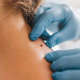 Mole Mapping